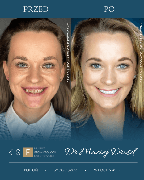 dr-drosd-kse-dental-camp-przed-po