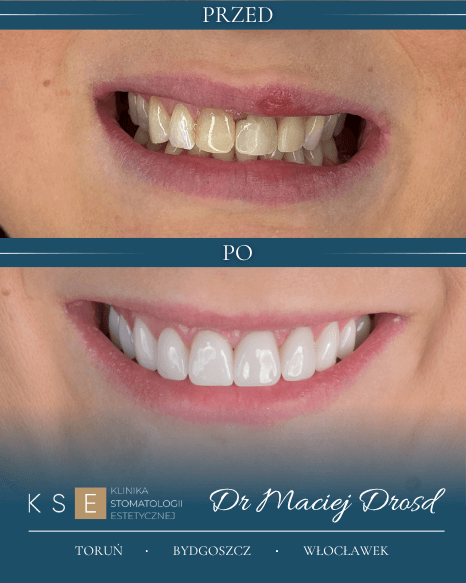 dr-drosd-metamorfoza-przed-po